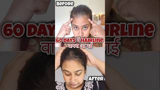 60 Days me Hairline वापस आ गए Try this Hair Growth Serum haircare hair hairgrowth shorts [upl. by Asamot]