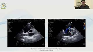 Approach to Congenital Cyanotic Heart Disease in neonatal period  Dr M Venkatesh [upl. by Selrac]