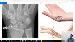 شرح كل كسور استقبال العظام فى ساعتين  16 Scaphoid Fracture [upl. by Haliled]