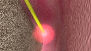 Laser Periodontal Therapy  WPT™ Animation [upl. by Nitsir]