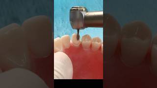 Crown preparation  Canine teeth teethstreet dentalprocedure dental [upl. by Thorr]