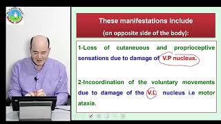 Thalamic syndrome [upl. by Lynelle]