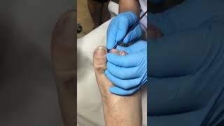 Ingrown toenail removal with Pedicure Knife Cut it easily Ep126 [upl. by Tema899]