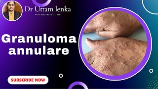 Granuloma annulare red circular rashes on skin Dr Uttam kumar Lenka skin and hair clinic [upl. by Wasserman350]