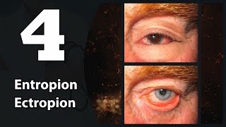 4 Eye lids Entropion amp Ectropion [upl. by Xuerd280]