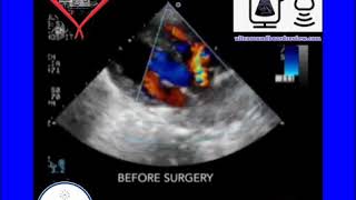 Ultrasound Board Review on Rastelli Palliative Procedure [upl. by Halona291]