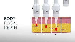 CFU Èlife latest generation focused ultrasound technology [upl. by Hildebrandt]