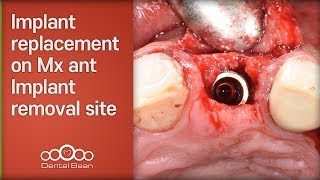 Implant replacement on Mx ant Implant removal site pre GBR and CT graft site  Dr Kim Jaeyoon [upl. by Liu531]