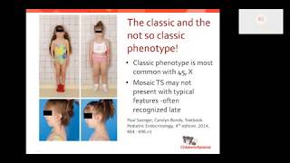 Turner syndrome Beyond the classic XO phenotype [upl. by Julide435]