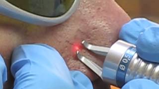 Dornier Medilas D FlexiPulse Laser Treatment [upl. by Carce]