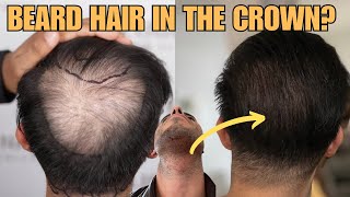 Can You Transplant Beard Hair In The Crown Dr Felipe Pittella Answers [upl. by Hose742]