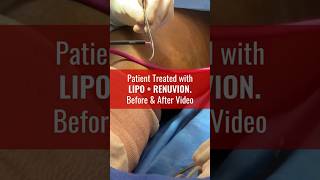 Amazing Patient Results after Liposuction amp Renuvion [upl. by Broddy]