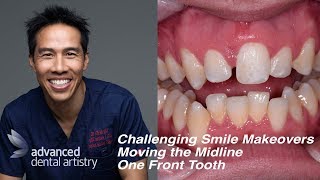 Difficult and Challenging Smile Makeover  One Central Tooth  Moving the Midline [upl. by Skiba]