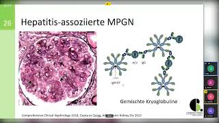 Membranoproliferative Glomerulonephritis  14062022 [upl. by Lexis]