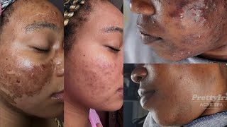 CLEAR ACNE PIMPLES WITH THESE THREE 3 TIPS [upl. by Drarehs]