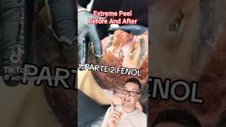 TW😱 SHOCKING CHEMICAL PEEL  Phenol Peel Before and After shorts [upl. by Howland]