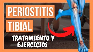 🦵PERIOSTITIS TIBIAL 💥 Qué es Causas Ejercicios y Tratamiento [upl. by Attenahs]