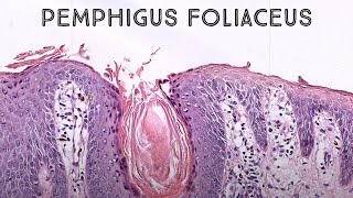 Pemphigus foliaceus autoimmune skin blister immunobullous disease in pemphigus vulgaris family [upl. by Hillel]