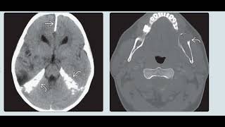 Sturge weber syndrome radiology [upl. by Euqinorev]