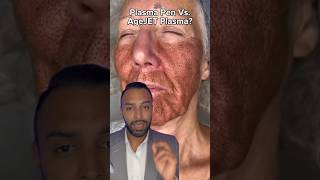 Plasma Fibroblast Vs AgeJet Plasma Which One Dr Somji Explains [upl. by Labina920]