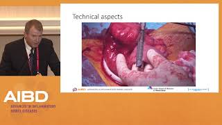 IBD Surgery Debate 1 Ileocecal Crohns disease [upl. by Maureen]