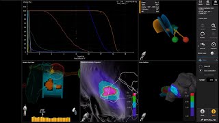 Radiosurgery Solution for the Treatment of Cranial Indications  Elements Cranial SRS [upl. by Lurlene]