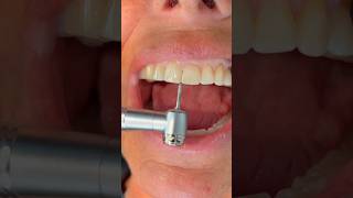 Reshaping Worn  Chipped Teeth After Braces Or Invisalign [upl. by Ativet703]