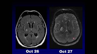 ShortTerm Delayed Imaging Effects of Gadolinium [upl. by Swinton]