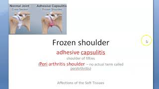 Orthopedics 323 Frozen Shoulder Arthritis adhesive capsulitis shoulder [upl. by Yxor]