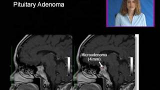 Anterior Pituitary Acromegaly and Giantism [upl. by Adnauqal]