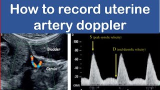 How to record uterine artery doppler [upl. by Lilli]