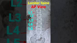 Lumber SpineLumber VertebraLSpineshort radiology xray [upl. by Inge]