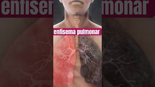 O Que é Enfisema Pulmonar Entenda a Doença que Atinge David Lynch [upl. by Rokach771]