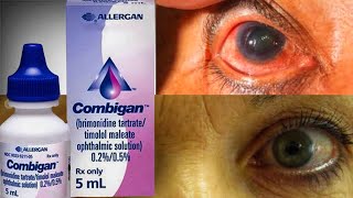 Combigan Eye Drop For Ocular Hypertension glaucoma  Brimonidine  Timolo [upl. by Nosiddam]