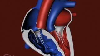 The Structure of a Heart with Transposition of the Great Arteries TGA  CHOP [upl. by Anitan]