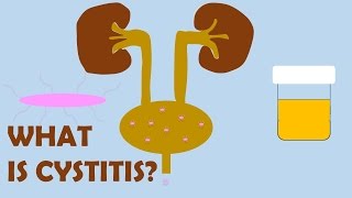 What is Cystitis [upl. by Westbrook]