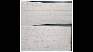 ECG Poor R wave progression from v1 to v5  CARDIOLOGY  Dr RakeshUkeyMD [upl. by Winifred]