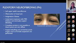 Pediatric Manifestations of Neurofibromatosis Type 1 Pediatric Grand Rounds Meeting 11 15 24 [upl. by Derag]