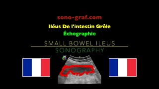 Échographie  Iléus De lintestin Grêle [upl. by Snehpets]