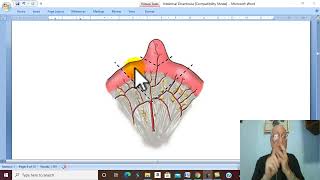 Intestinal Disorders in Arabic 7  Meckels Diverticulum   by Dr Wahdan [upl. by Akinuahs]