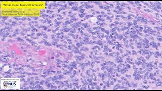 Medulloblastoma microscopy  Talking slide [upl. by Dnomsad21]