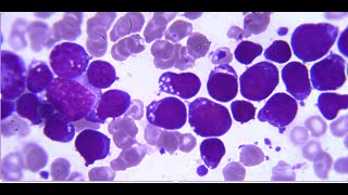 Burkitt Lymphoma [upl. by Annis]