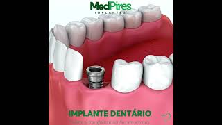 Vídeo ilustrativo demonstrativo da colocação do implante dentário unitário e coroa [upl. by Mcgregor246]