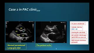 10 Perioperative Echocardiography For Anesthesiologists Real Practical Cases [upl. by Notsag]