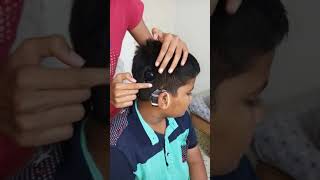 Introduction of cochlear implants [upl. by Yarb]