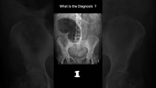 Caecal volvulusAbdominal Xray  Abnormalities  Caecal volvulus 76 radiologychannel007 [upl. by Daus]