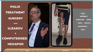 POST POLIO SYNDROME TREATMENT Malignant Multiple Malalignment Syndrome Resolving Hand Thigh Gait [upl. by Htesil]