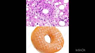 Doughnut Granulomas AKA Fibrin Ring Granulomas are seen in Q Fever [upl. by Lothaire]