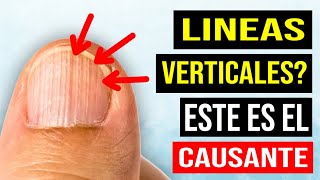 Causa de las lineas verticales en las uñas [upl. by Yesnyl]