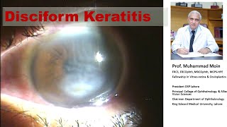 Disciform Keratitis [upl. by Esihcoc]